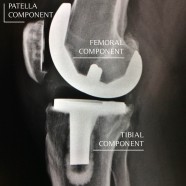 X-ray of knee replacement