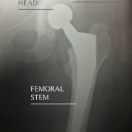 X Ray Hip Replacement